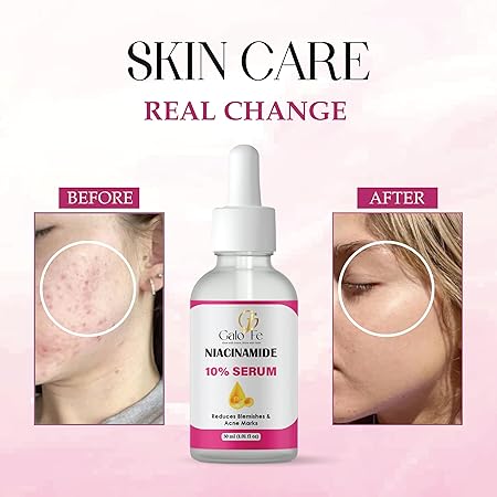 Niacinamide 10% Serum, Reduces Blemishes and Acne Marks, Face Serum, 30 ml