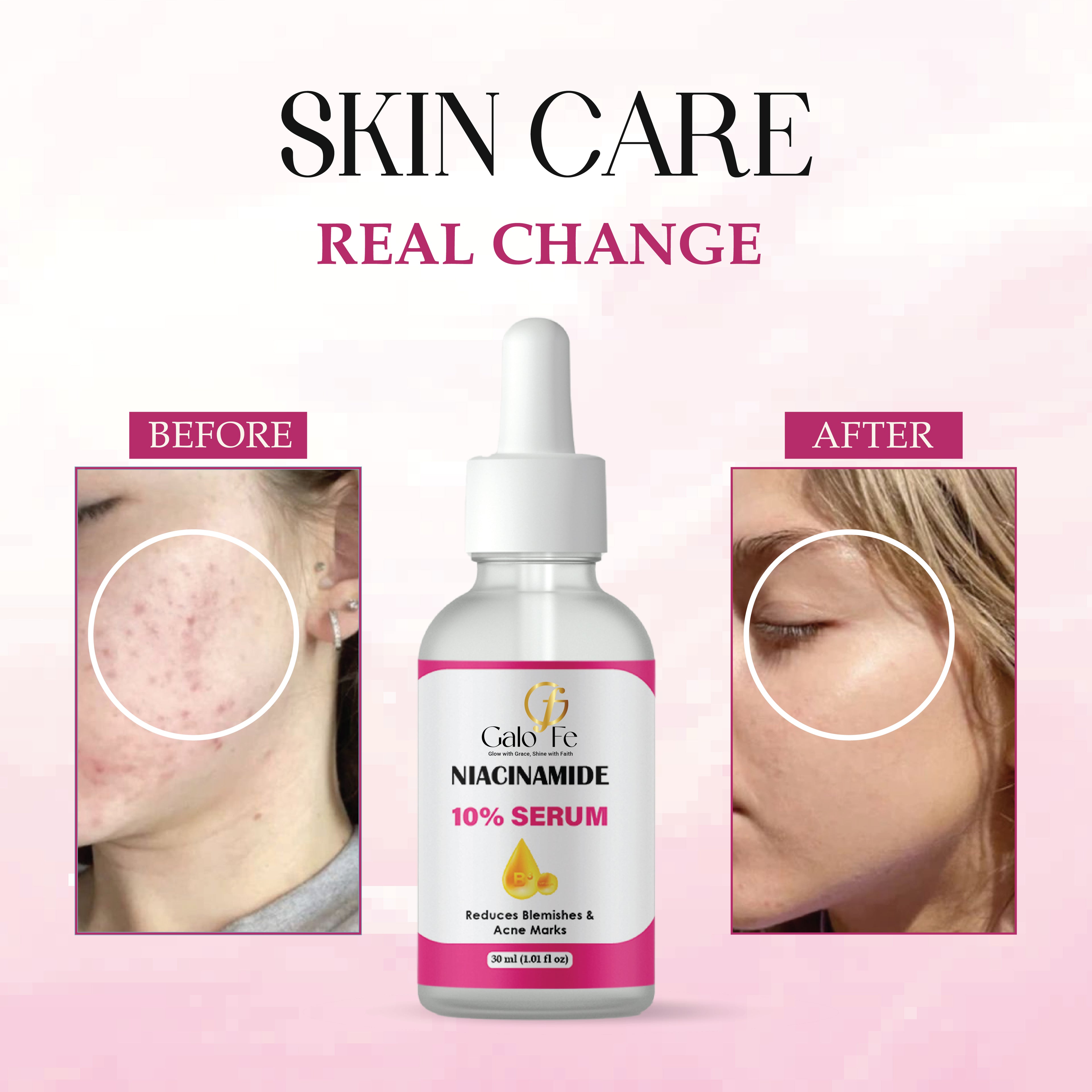 Galo Fe Niacinamide 10% Serum, Reduces Blemishes and Acne Marks, Face Serum, 30 ml